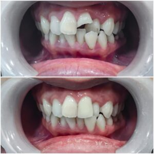 photo d'un bridge dentaire avant et après