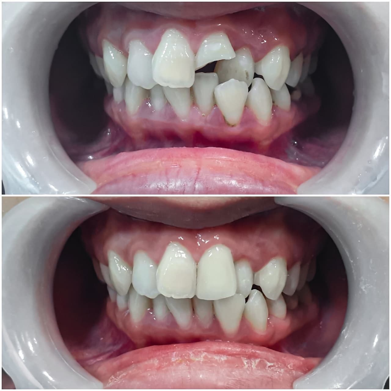 You are currently viewing Pose d’un bridge dentaire : solutions, avant/après et tarifs