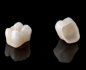 Lire la suite à propos de l’article Couronne céramo-céramique : prix, avantages et déroulement de la pose