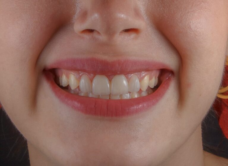Lire la suite à propos de l’article Cicatrisation des dents de sagesse : le guide complet pour une guérison rapide