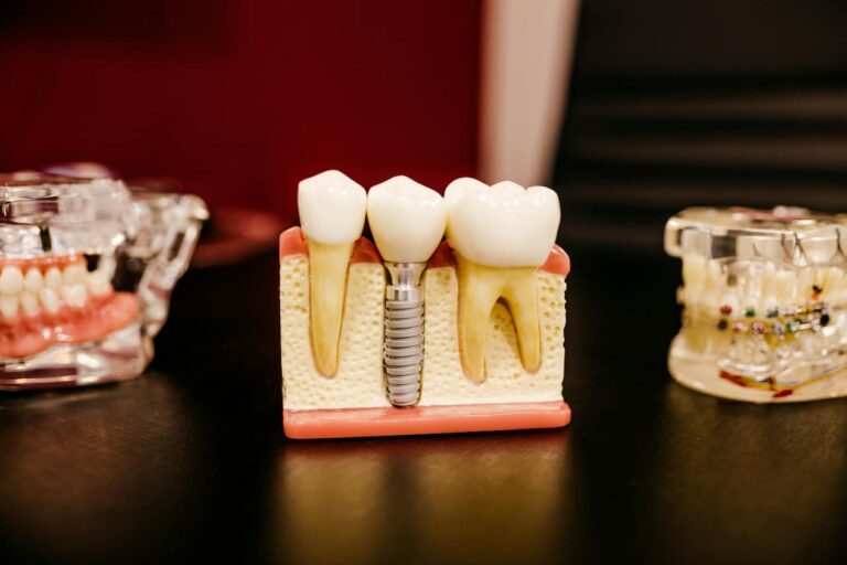 Lire la suite à propos de l’article Combien de séances pour la pose d&rsquo;un implant dentaire ?