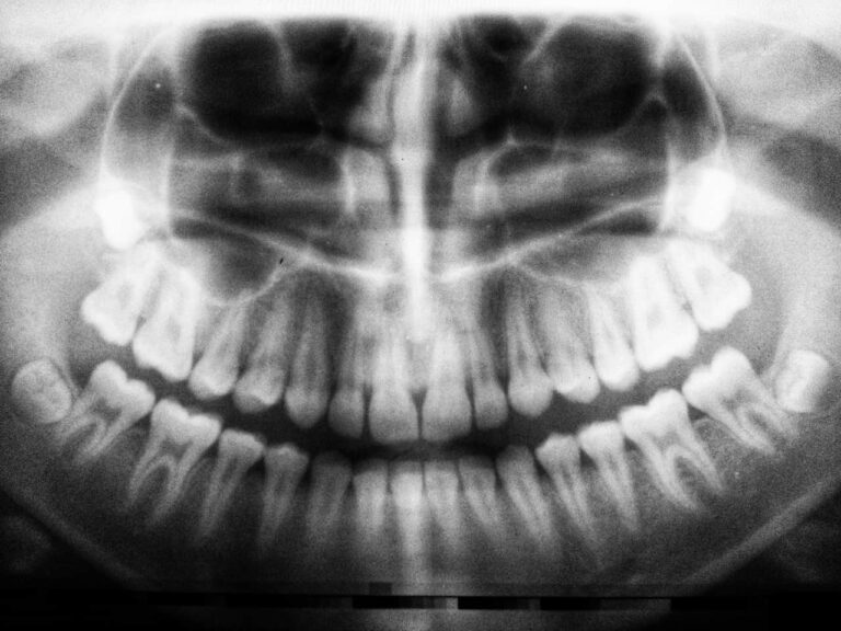 Lire la suite à propos de l’article À quoi servent les dents de sagesse et faut-il vraiment les retirer ?