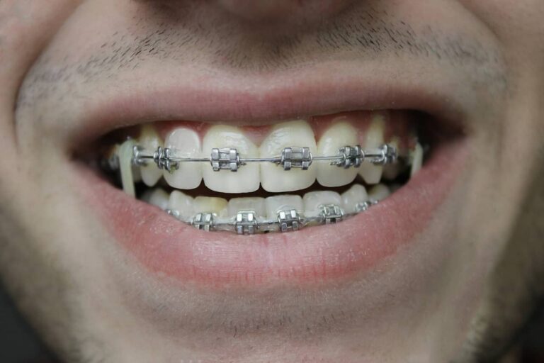 Lire la suite à propos de l’article Bague dentaire céramique ou métal : comment choisir le meilleur appareil ?