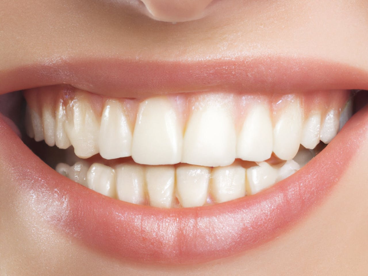 You are currently viewing Taches blanches sur les dents : causes, traitements et prévention