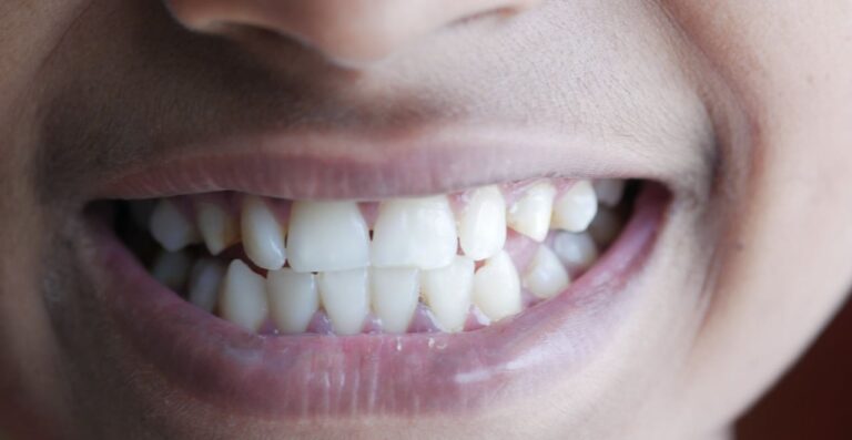 Lire la suite à propos de l’article On a combien de dents : adulte, enfant et dents de sagesse