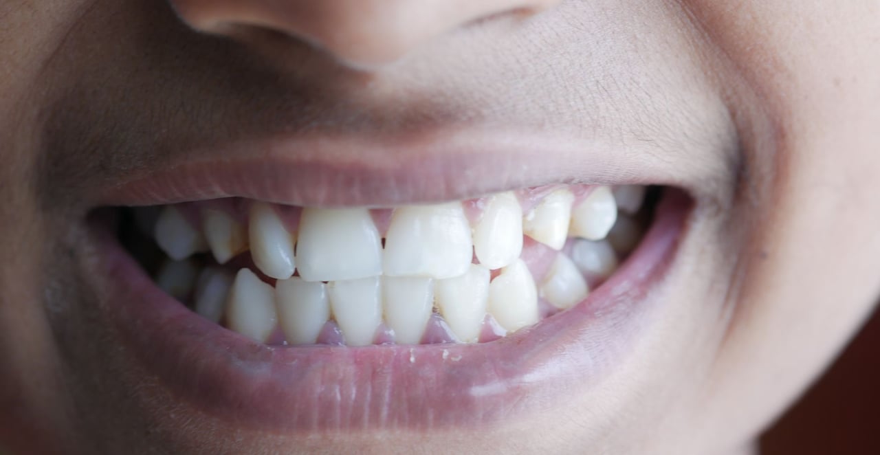 You are currently viewing On a combien de dents : adulte, enfant et dents de sagesse